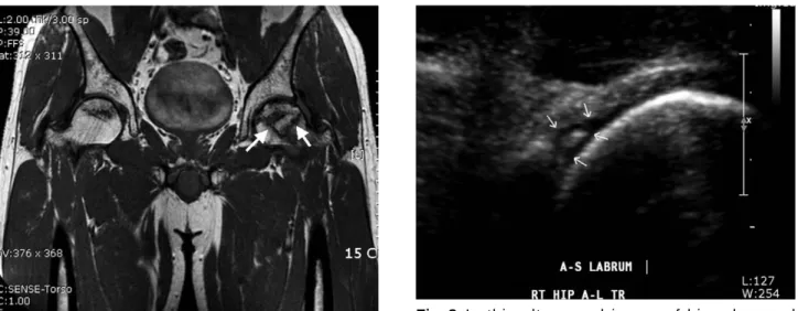 Fig. 8. In this ultrasound image of hip, abnormal hypoechoic gap between the acetabular labrum and bony acetabulum suggests labral tear