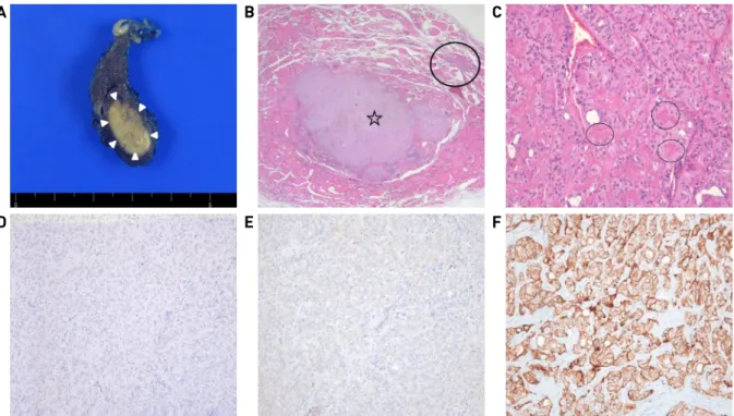 Fig. 3. Pathological findings. The surgical specimen shows that 1.5 X 0.8cm sized well-defined ovoid solid mass is present in  the lower pole of right thyroid (arrowheads)(A)