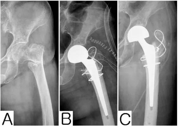 Fig. 1. These pictures - anteroposterior(upper row) and lateral(lower row) view - show the methods for fixation of greater trochanteric fragment