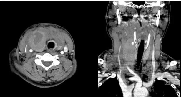 Fig. 1. Contrast enhanced computed tomography scan shows the right thyroid hematoma and tracheal deviation.
