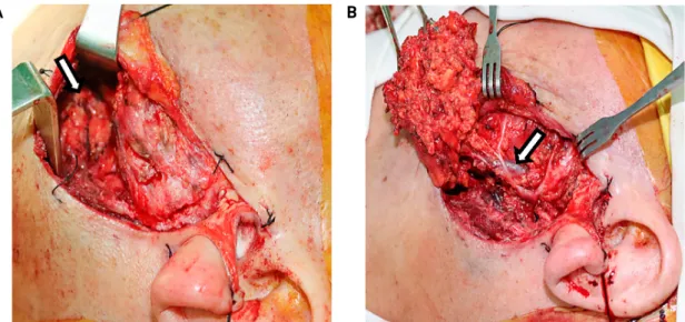 Fig. 2. Operative findings. The enlarged lymph node is observed in the upper neck (arrow)(A)
