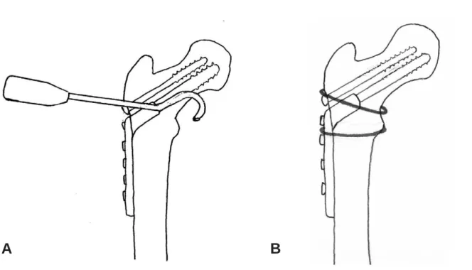 Fig. 1. Techniques for cable fixation of lesser trochanter. (A) With the cable passer, cable is passed through the lesser trochanter
