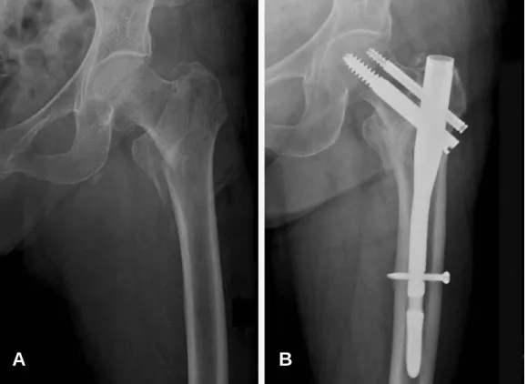 Fig. 1. A 72-year-old female sustained an A22 AO/OTA intertrochantertic fracture (A). She was treated with internal fixation with PFN, and the radiograph taken 12 months postoperatively shows complete healing of the fracture (B).