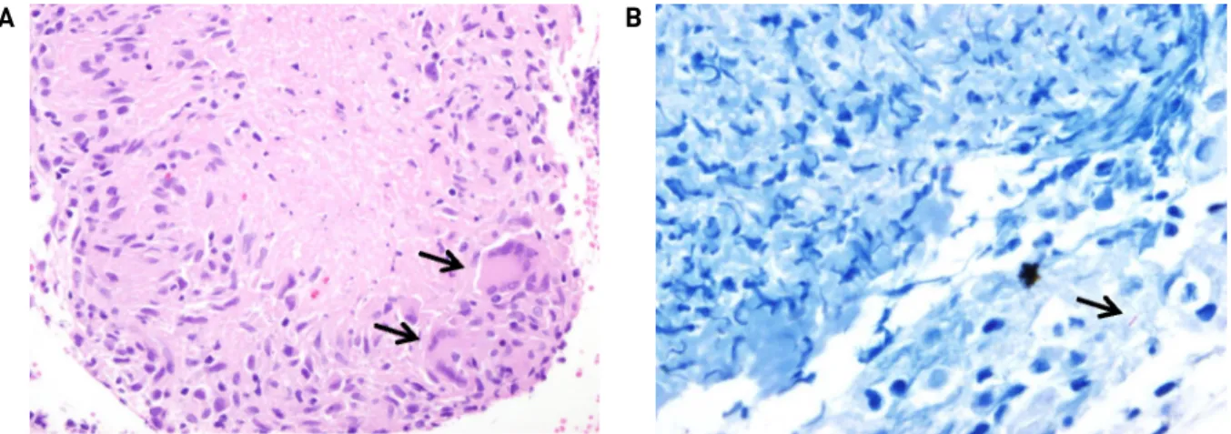 Fig. 3. (A) The microscopic examination revealed multiple areas of chronic granulomatous inflammation with caseous necrosis