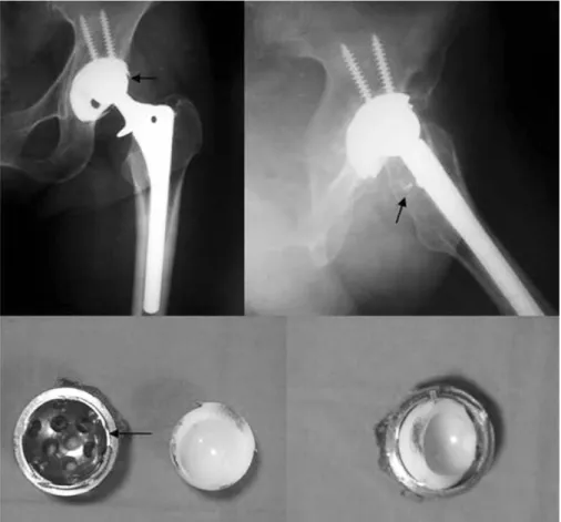 Fig. 1. Plain radiograph at postoperative 10 years shows osteolysis, eccentric position of the prosthetic head and dissociation of polyethylene liner