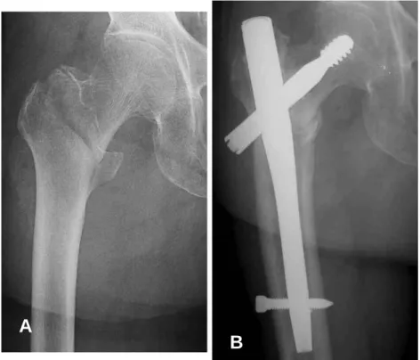Fig. 1. AP view (A) and Lateral (B) view of a trochanteric fracture treated with Gamma nail.