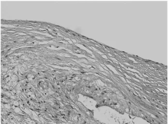 Fig. 3. Photomicrograph of histopathologic specimen shows thick-walled cyst with myxoid change in matrix