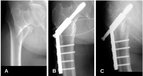 Fig. 4. (A) A 82-year-old female sustained an A2, 2 intertrochantertic fracture. (B) She was treated with compression hip screw