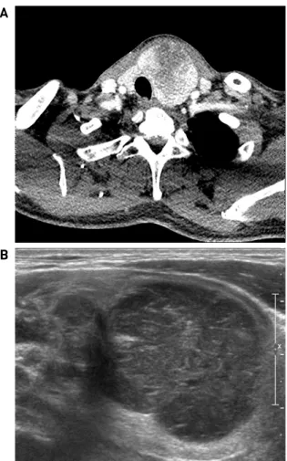 Fig. 1. (A) Neck computed tomography showed 5.5cm heter- heter-ogeneous nodule of left thyroid gland causing diffuse bulging  and tracheal deviation to the right