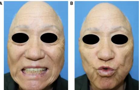 Fig. 4. Postoperative facial photographs. They show normal facial expression including lip movements (A and B).