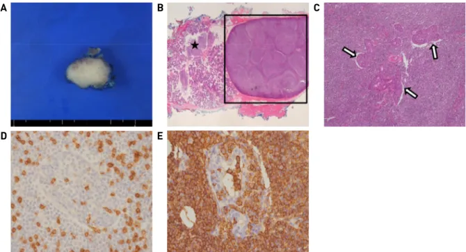 Fig. 5. Histopathological findings. The surgical specimen shows that 2.2x1.5 cm sized mass with grayish white firm cut surface  (A)