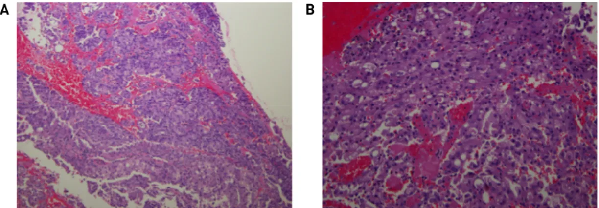 Fig. 3. The lesion of pathology stained with periodic acid–chiff (PAS) staining. A: The tumor shows microcystic and tubular growth patterns