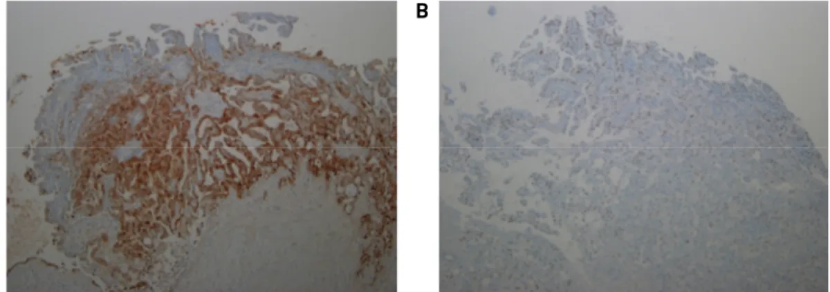 Fig. 4. The lesion of pathology analyzed with immunohistochemical staining. A: Diffuse reactivity for the S-100 protein