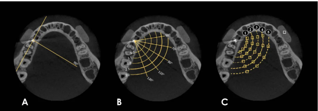 Table 1 shows the mean SDs obtained at each distance  for each intracanal material with varying current and with  or without the activation of the MAR tool