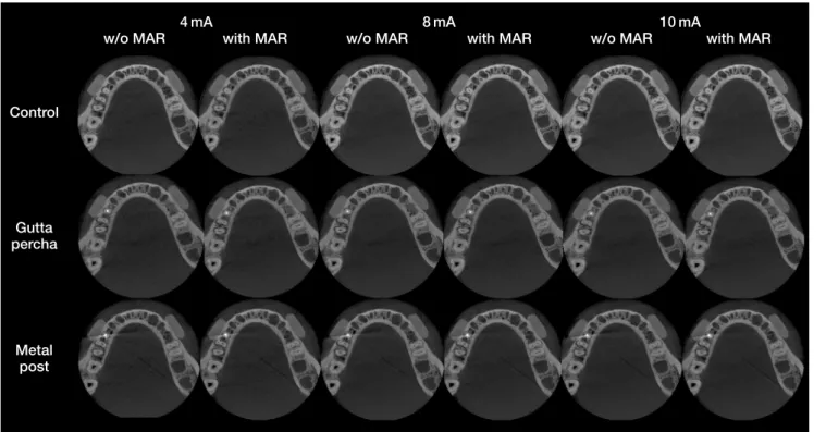 Fig. 2.  Axial images represent intracanal materials (control in the first row, gutta-percha in the second row, and metal post in the third row)  with different tube currents (4 mA, 8 mA, and 10 mA) and without and with the application of a metal artifact 