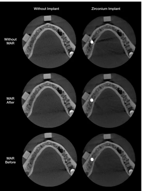 Fig. 1.  Examples of cropped axial images of the control and zirconium groups in various metal artifact reduction (MAR) conditions: with- with-out MAR, MAR after acquisition, and MAR before acquisition.