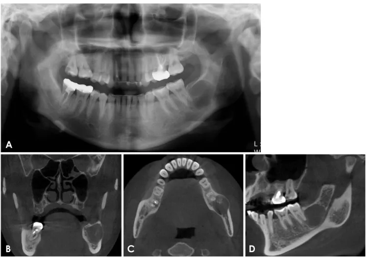 Fig. 1.  A. A panoramic radiograph showing an oval-shaped radiolucency with a well-defined border in the left posterior mandible
