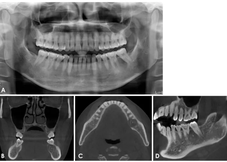 Fig. 2.  A. A panoramic radiograph shows a round radiolucency around the distal root of the left first mandibular molar