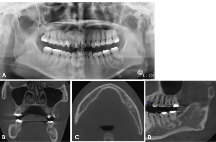 Fig. 4.  A. A panoramic radiograph shows a round radiopaque lesion surrounded by a radiolucent rim around the roots of the left first and  second mandibular molars