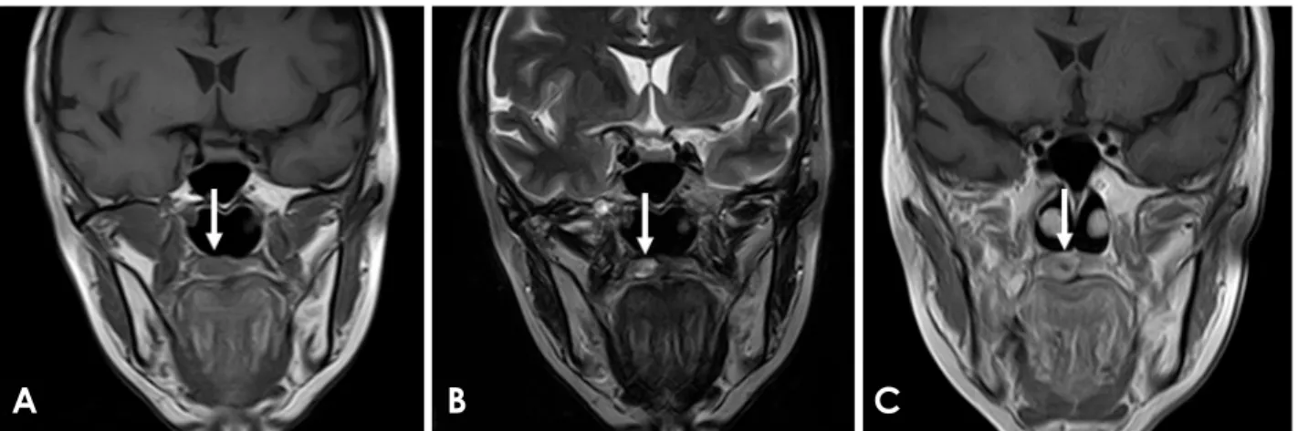 Fig. 3.  Magnetic resonance image of a myoepithelioma of the palate in a 54-year-old woman (arrows)