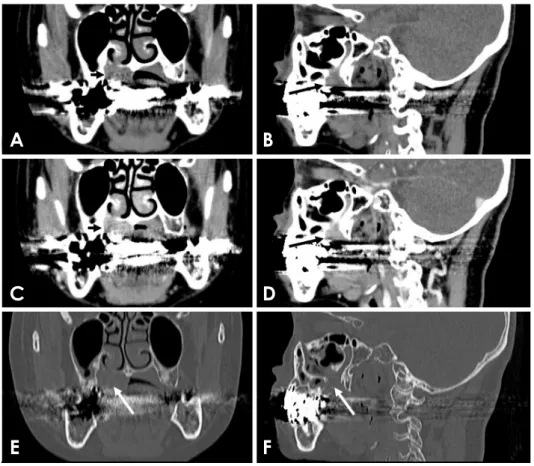 Fig. 7.  Magnetic resonance imaging of an adenoid cystic carcinoma of the palate in a 70-year-old woman (arrows)