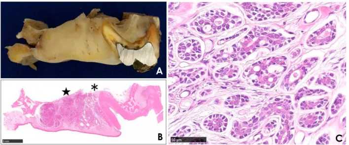 Fig. 8.  Specimen and histopathological exam of an adenoid cystic carcinoma of the palate in a 70-year-old woman