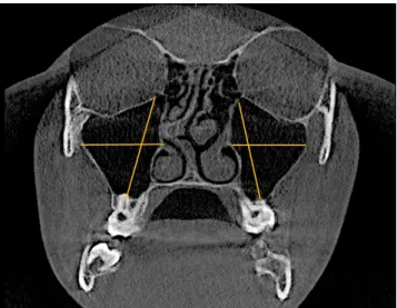 Fig. 2.  Measurement of maxillary sinus height (from the lowest point  of the sinus floor to the highest point of the sinus roof) and width (from  the longest perpendicular distance from the medial wall of the sinus  to the outermost point of the lateral w