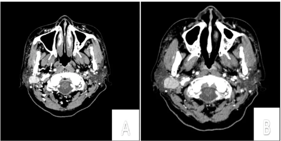 Fig. 1. (A) In 2014, Skull base CT axial scan show about 1.8 x 1.2cm sized well-defined enhancing mass in the right parotid  gland