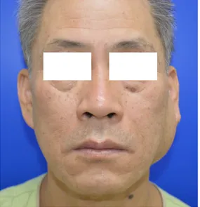 Fig. 1. Clinical photograph shows a diffuse huge mass of left parotid area, but no facial weakness.