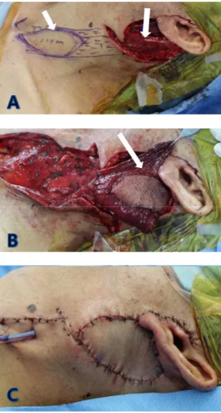 Fig. 4. The resected specimen (left parotid gland). About  7.6×5.0 cm sized, parotid parenchyma was nearly replaced  by  lymphoma