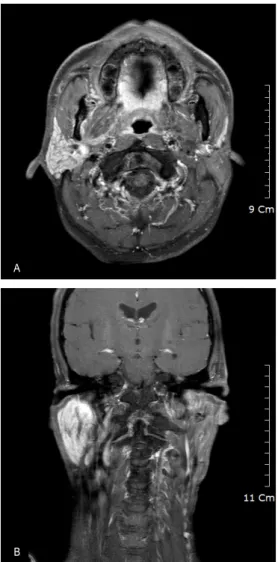 Fig. 7. Postoperative MRI T1-weighted scan axial view(A) and  sagittal view(B) shows successfully removed left parotid mass  with SCM musculocutaneous flap without local recurrence at  8 month after the surgery