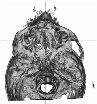 Fig. 8.  Three-dimensional axial orientation of patient No. 13 show- show-ing how, given the distortion of his skull base, the mid-sagittal plane  was not suitable for dividing the skull into 2 perfectly symmetric  anatomical halves: measurements of this p