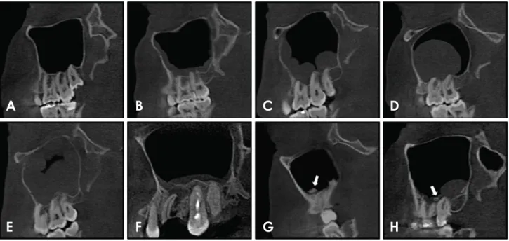 Fig. 1.  Sagittal sections of cone-beam computed tomography show examples of maxillary sinus abnormalities