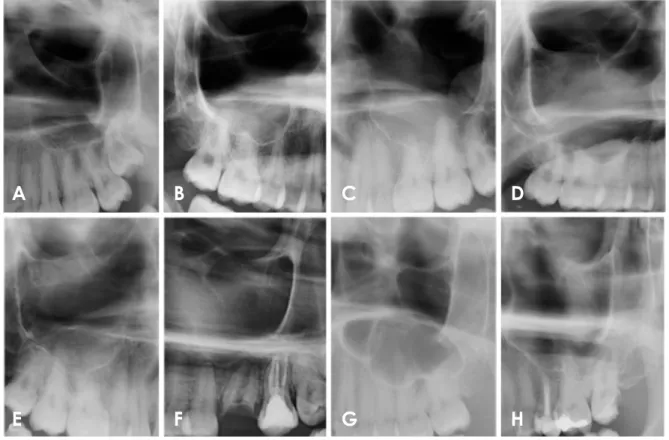 Fig. 2.  Sections of cropped panoramic radiographs show examples of maxillary sinus abnormalities