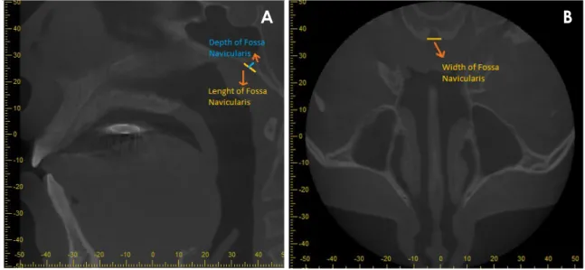 Fig. 1.  A. Measurements of fossa navicularis depth and length on a sagittal image. B