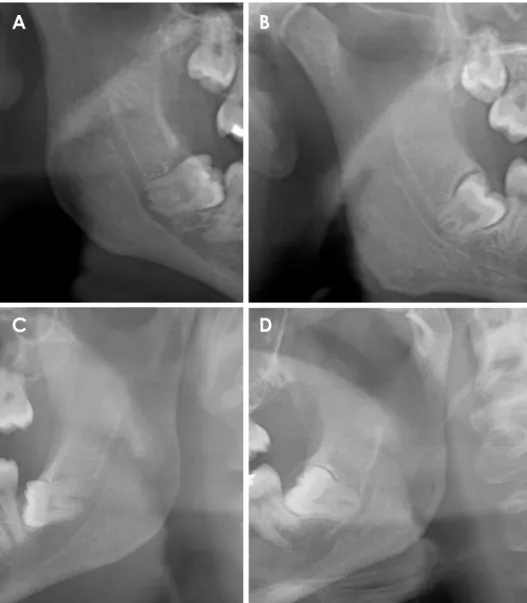 Fig. 1.  Cropped panoramic images  show darkening of the roots (A),  diversion of mandibular canal (B),  interruption of the mandibular  ca-nal wall (C), and narrowing of the  mandibular canal (D).