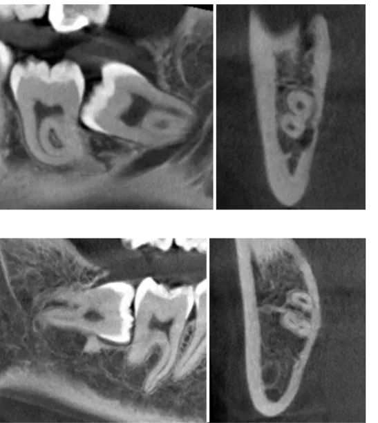 Fig. 2.  Lingually positioned inferior  alveolar canal without cortication.