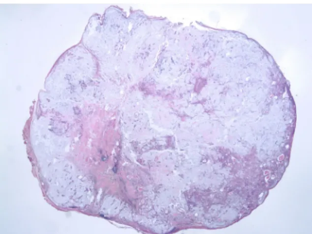 Fig. 1. Preoperative computed tomography neck image  shows 21 x 18 x 16mm hypoechoic mass(white arrow)  in-volving right submandibular gland and multiple 4~15mm  lymph nodes(black arrow) in right submandibular space