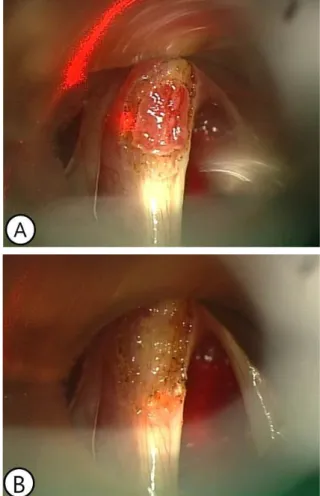 Fig. 2. Laryngomicrosurgery with laser. (A) Demarcation of  excision extent using CO 2  laser was done with 2 mm  ex-cision margin
