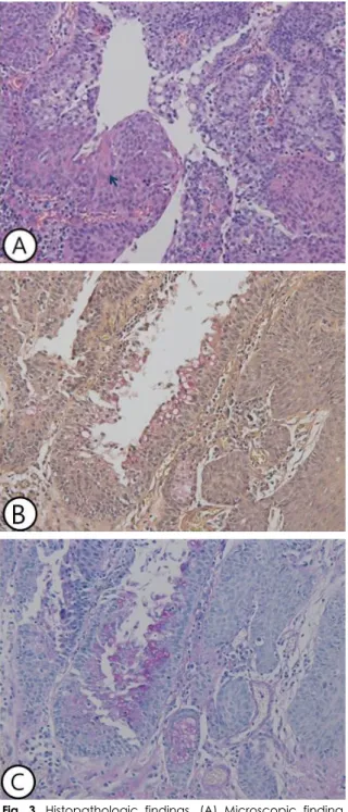 Fig. 4. Post-operative laryngoscopic finding. There was no  definitive mass lesion. The mucosal wave around previous  lesion-site was restored