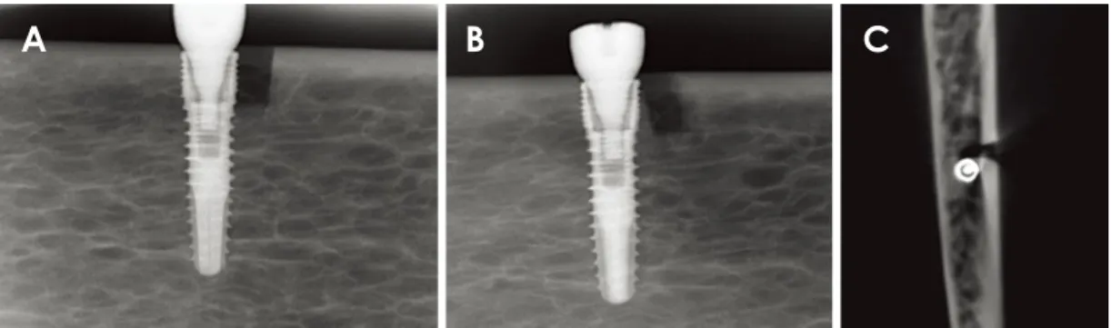 Fig. 3.  Radiographic images of a 2-wall angular defect. A. Parallel periapical radiograph