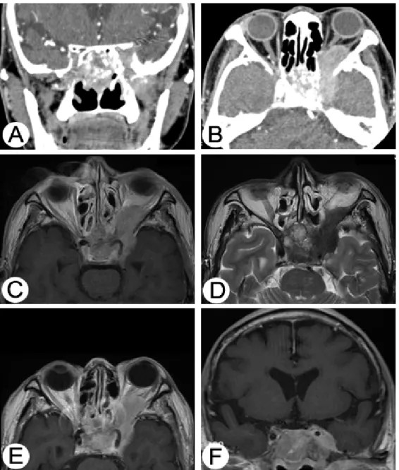 Fig. 5. Coronal (A) and axial (B) CT scans demonstrating mass invading sphenoidal sinus, left cavernous sinus, left optic nerve and  middle cranial fossa