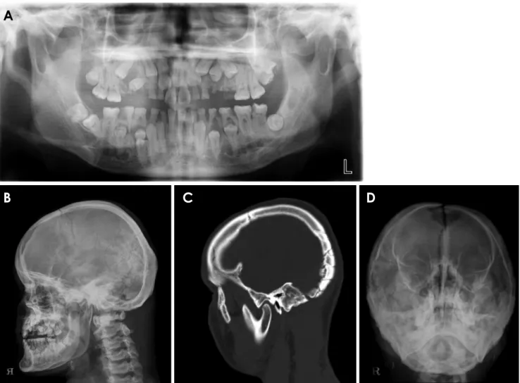 Fig. 4.  Case 2. A. Panoramic radiograph of a 23­year­old male patient shows multiple impacted permanent teeth and prolonged retention  of numerous deciduous teeth