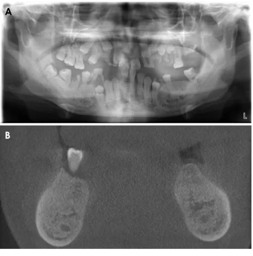Fig. 6.  Case 2. Chest radiograph of a 35­year­old patient shows a  congenital ossification defect in both distal third clavicles, which  are displaced