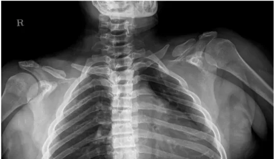 Fig. 9.  Case 3. Chest radiograph of  a 46­year­old woman shows under­