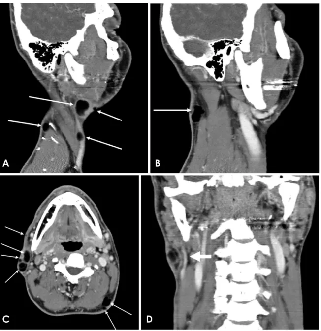 Fig. 2.  Contrast-enhanced computed tomographic imaging features of steatocystoma multiplex of the bilateral cervical subcutaneous area