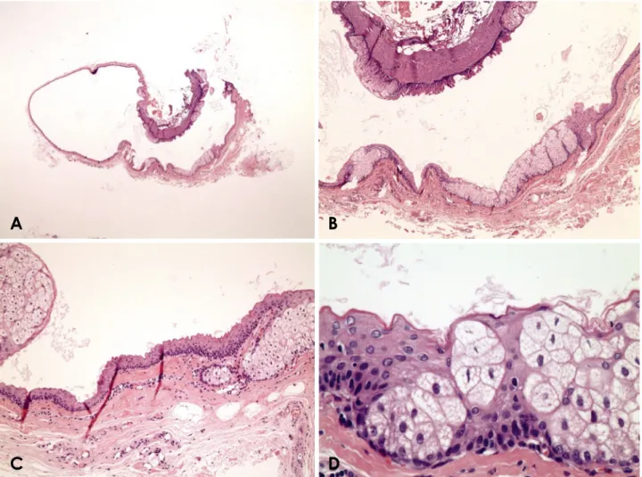 Fig. 3.  Histological findings of the excisional biopsy specimen. A. Overall view of the biopsy specimen showing a cavity surrounded by a  folded cyst wall in the subcutaneous tissue