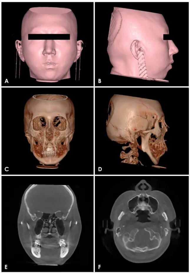 Fig. 6.  Cone-beam computed tomography (CBCT) images. A-D. Three-dimensional reconstructed CBCT images demonstrate mandibular  retrusion, asymmetry, and low-set ears