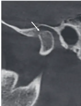 Table 4.  The comparison between the computed tomographic (CBCT) findings in the control and rheumatoid arthritis (RA)  groups CBCT findings Control (N=28) RA (N=28) Erosion 10 (35.7%)  24 (85.7%)* Flattening 14 (50.0%)  25 (89.3%)* Osteophyte formation 2 