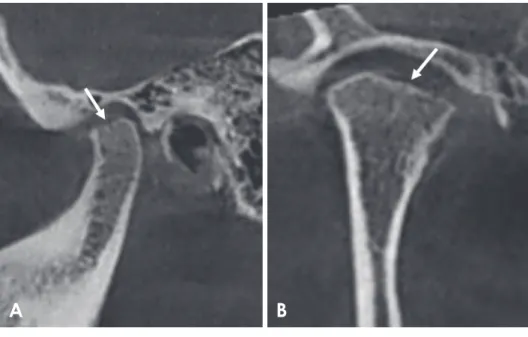 Fig. 3.  Reformatted cone-beam  computed tomographic images of a  rheumatoid arthritis patient showing  flattening of the condyle